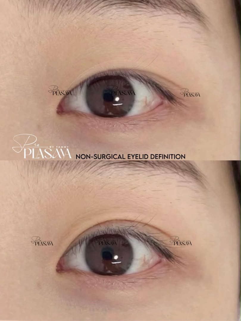 Pro Plasma